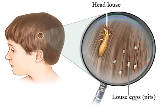 Head lice and eggs