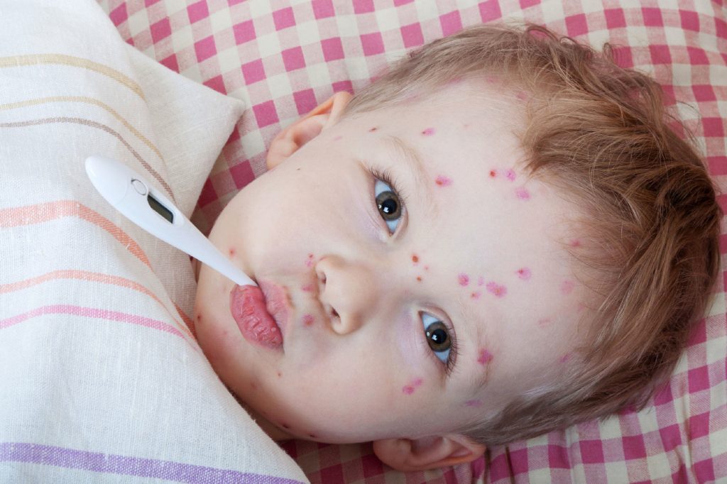 measles viral infection preventive measures protection disease