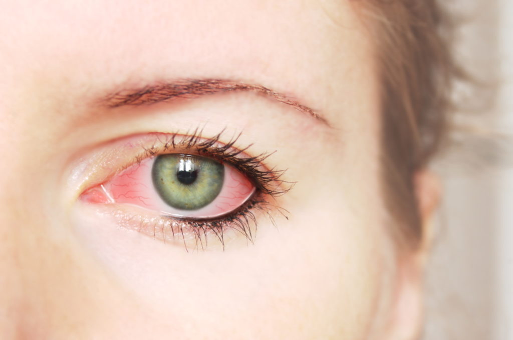 conjunctivitis infection possible preventions
