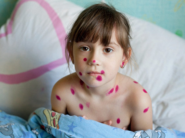 chickenpox viral infection causes symptoms prevention child